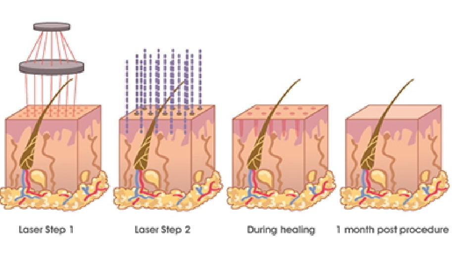 Láser CO2 3 - Midis Laser